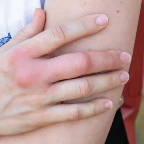 anti-inflammatory.webp